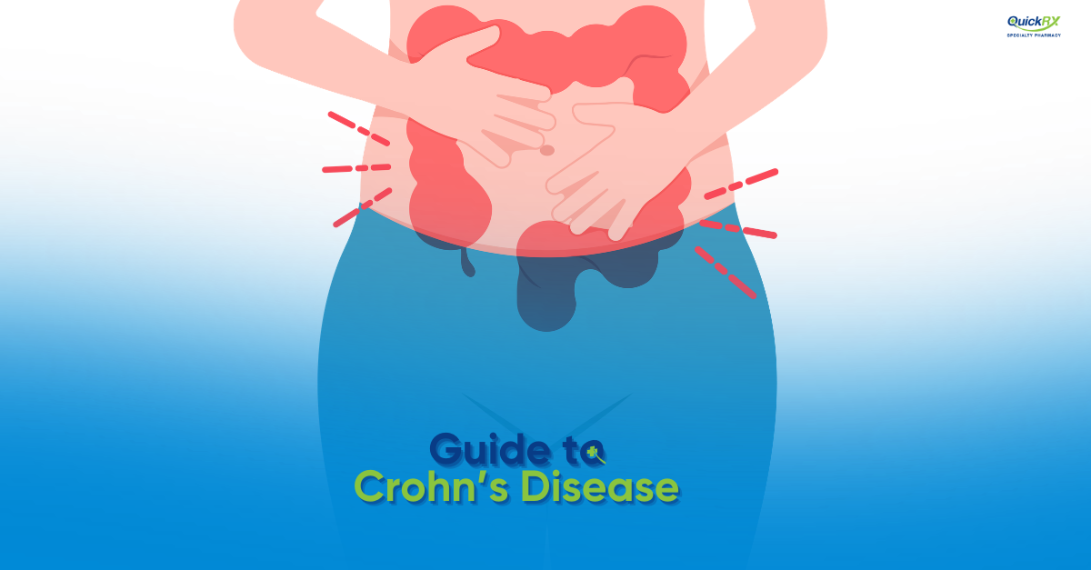 Illustration of a person holding their abdomen with red inflammation over the intestines, for a QuickRX Specialty Pharmacy guide to Crohn's disease