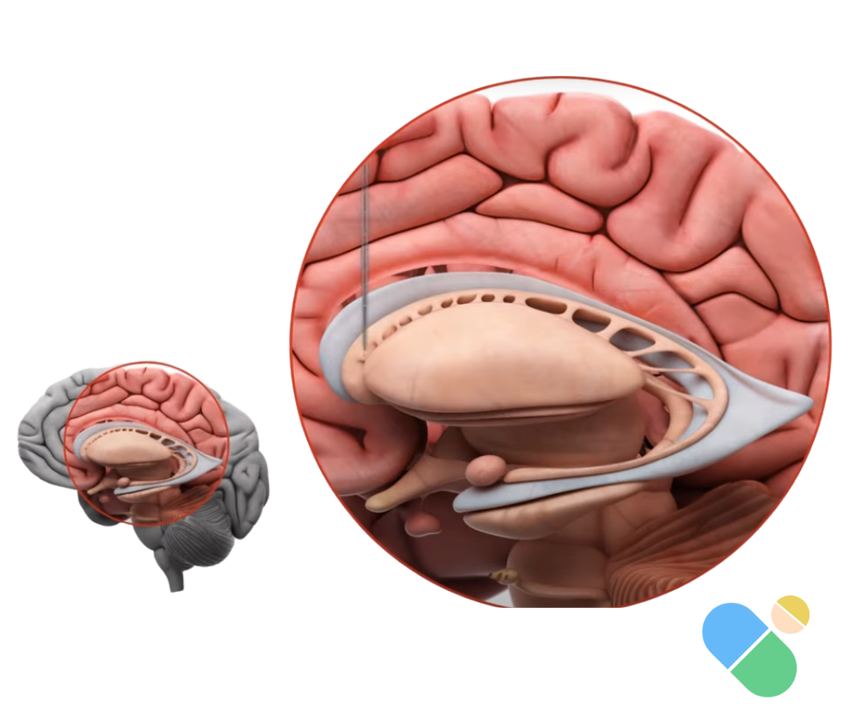 Anatomical cross-section of human brain showing the striatum, caudate nucleus and putamen - the regions targeted by AMT-130 gene therapy for Huntington's disease