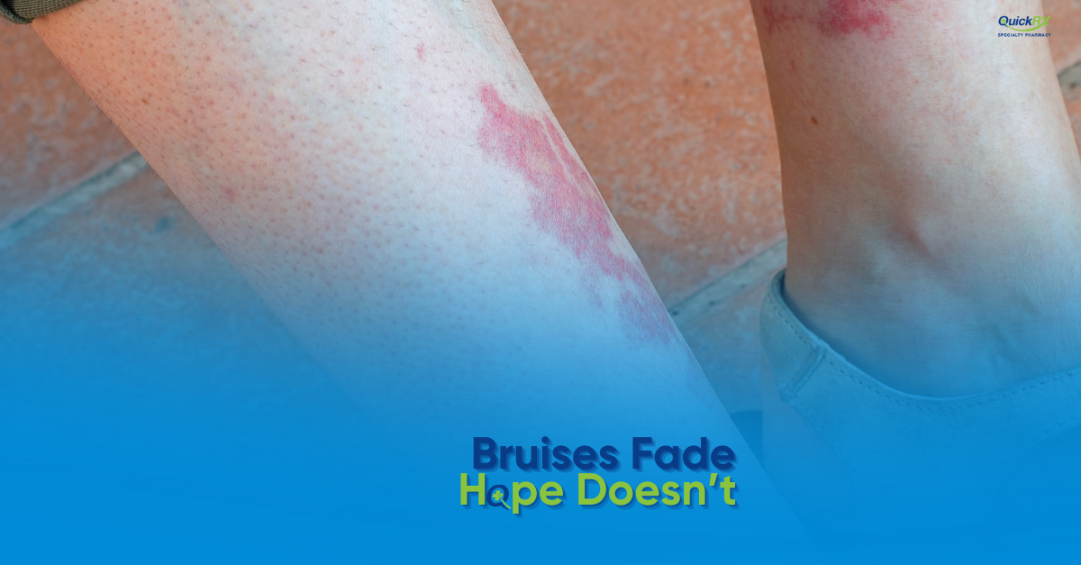 Multiple bruises on legs showing ITP symptoms - immune thrombocytopenia causes easy bruising from low platelet counts