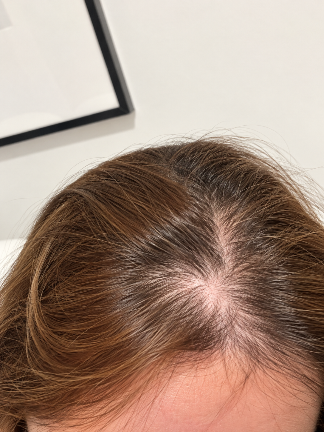 Close-up view of thinning hair at the crown and visible scalp